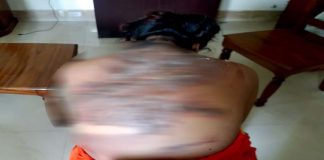 কবিরাজের গরম পানিতে নবম শ্রেণির ছাত্রীর শরীর ঝলসে গেলো