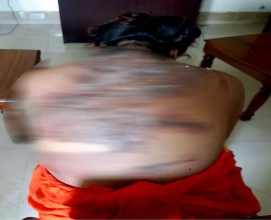 কবিরাজের গরম পানিতে নবম শ্রেণির ছাত্রীর শরীর ঝলসে গেলো