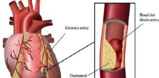 হার্টের রিংয়ের দাম কমছে