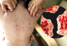 হামের উপসর্গ নিয়ে আরও ৮ জনের মৃত্যু