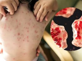 হামের উপসর্গ নিয়ে আরও ৮ জনের মৃত্যু