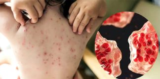 হামের উপসর্গ নিয়ে আরও ৮ জনের মৃত্যু