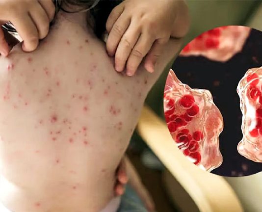 হামের উপসর্গ নিয়ে আরও ৮ জনের মৃত্যু