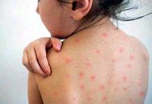 হাম : এক দিনে ৮ শিশুর মৃত্যু, শনাক্ত ১৪৩ জন