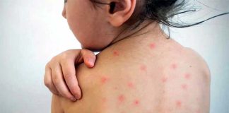 হাম : এক দিনে ৮ শিশুর মৃত্যু, শনাক্ত ১৪৩ জন