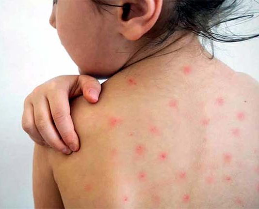 হাম : এক দিনে ৮ শিশুর মৃত্যু, শনাক্ত ১৪৩ জন