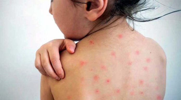 হাম : এক দিনে ৮ শিশুর মৃত্যু, শনাক্ত ১৪৩ জন