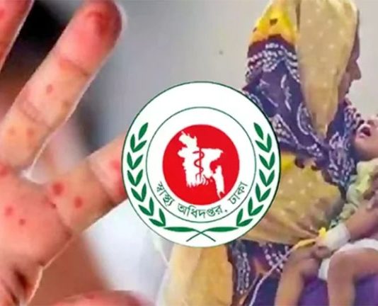 হাম ও উপসর্গে আরও ৭ মৃত্যু