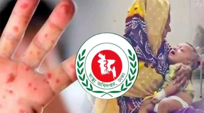 হাম ও উপসর্গে আরও ৭ মৃত্যু